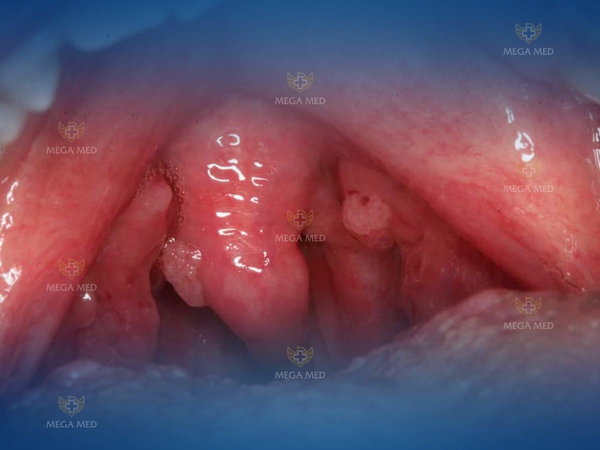 Sùi mào gà có nguy hiểm không